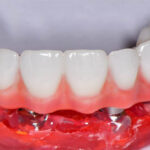 Rapid Digital Conversion