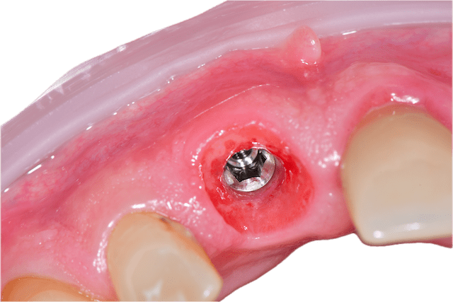 Clinician explaining an implant model to a smiling patient