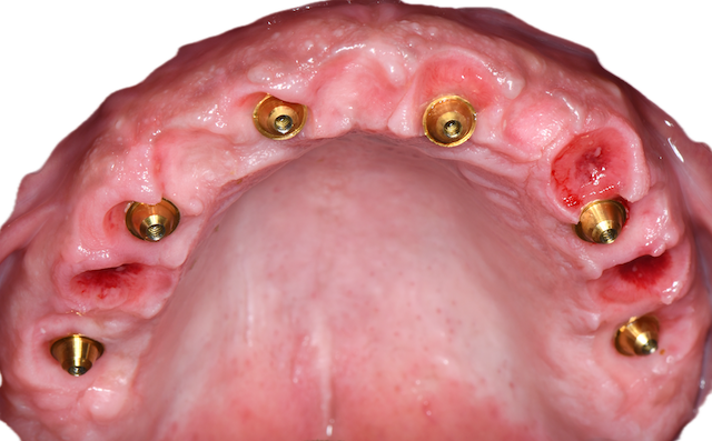 Full-arch implant rehabilitation in the mouth