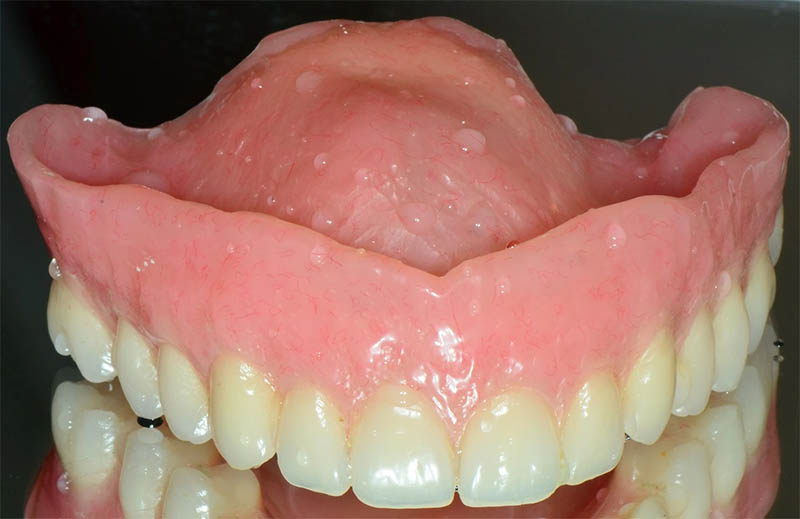 Finished complete denture with natural esthetics