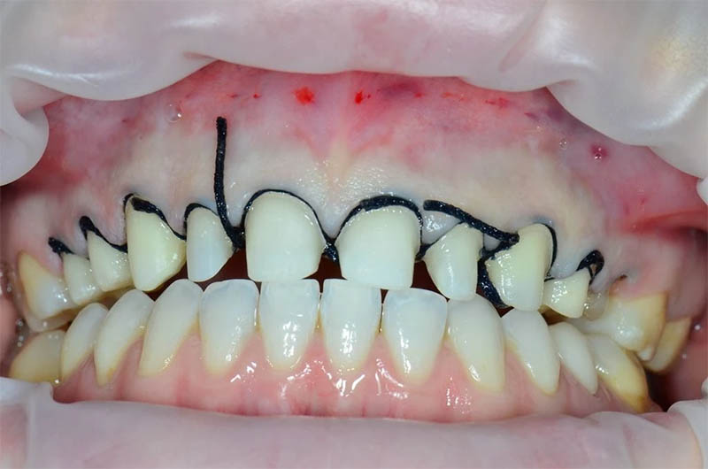 Esthetic markup drawn on teeth during smile design