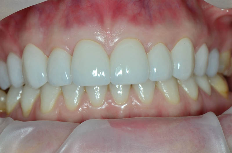 Natural, individualized smile restoration