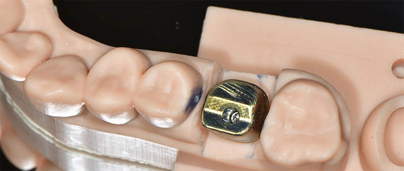 Model with implant analog and restorative components