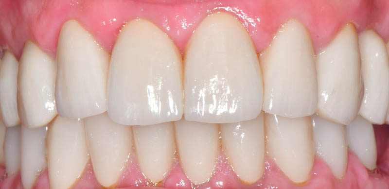 Natural, individualized smile restoration