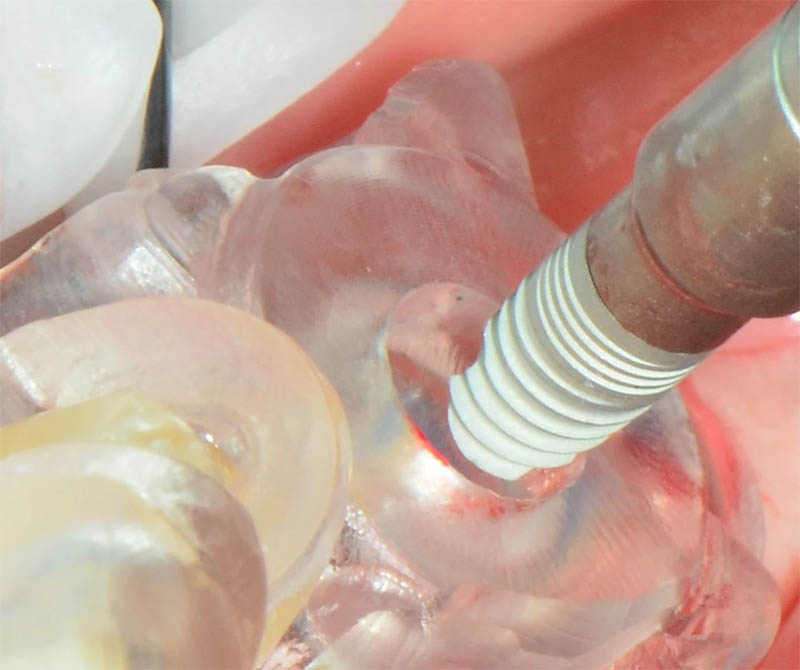 Implant placed through a static surgical guide